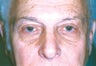 Blepharoplasty & Ptosis