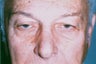 Blepharoplasty & Ptosis