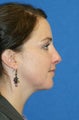 Submental Liposuction