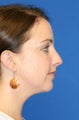 Submental Liposuction