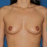 Breast Augmentation
