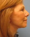 Facelift