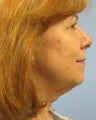 Facelift