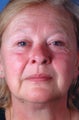 Photofacial (Intense Pulsed Light)