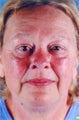 Photofacial (Intense Pulsed Light)