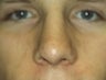 Male patient who underwent nose surgery 