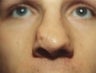 Male patient who underwent nose surgery 