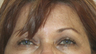 60 year old female status post in Office Setting Bilateral Brow Lift.