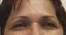 60 year old female status post in Office Setting Bilateral Brow Lift.