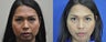 36 year old female treated for weak chin, double chin, and excess buccal fat