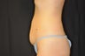 CoolSculpting Before and After Lower Abdomen