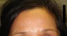 Brow Lift