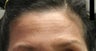 Brow Lift