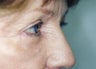 Eyelid Surgery