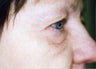 Eyelid Surgery