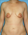 Breast Lift