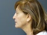 74yo female before Ultherapy for face and neck