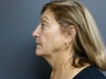 74yo female before Ultherapy for face and neck