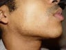 Laser Hair Removal