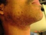 Laser Hair Removal