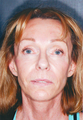 Laser Skin Resurfacing