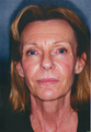 Laser Skin Resurfacing