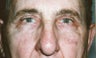Blepharoplasty