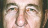 Blepharoplasty