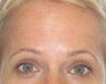 42 year old treated for forehead rhytids (wrinkles)