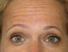42 year old treated for forehead rhytids (wrinkles)