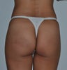 41 year old female with an uneven left buttock contour due to a fall
