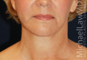 Neck Lift
