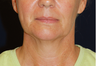 Neck Lift