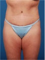 Post pregnancy body contouring