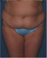 Post pregnancy body contouring