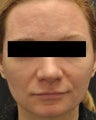 Acne Scarring
