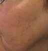 Age Spots Treatment