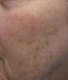 Age Spots Treatment