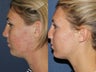 Before & After Fraxel Restore
