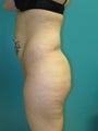26 year old woman having liposuction of abdomen, back, buttocks and thighs