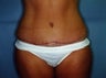 Tummy Tuck