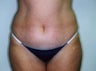 Tummy Tuck