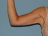 Brachioplasty and VASER LipoSelection of her upper arms. 