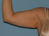 Brachioplasty and VASER LipoSelection of her upper arms. 