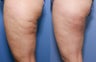 37 year old with cellulite