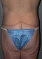 45 year old female patient 