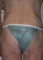 45 year old female patient 