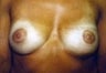 44 year old female patient 