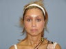 Face Lift