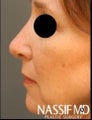 Female Revision Rhinoplasty 